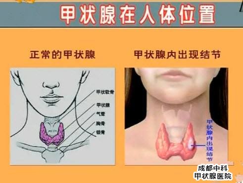 成都甲亢医院416？甲状腺疾病的危害与治疗方式